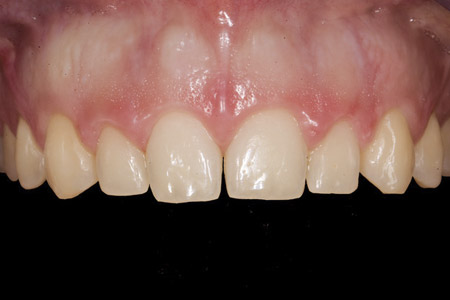 Periodoncia antes