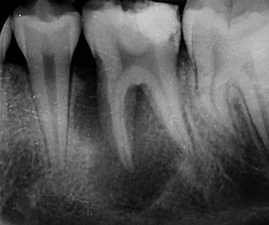 endodoncia antes