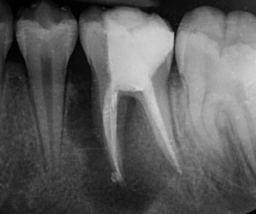 endodoncia después